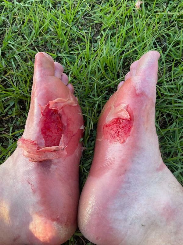 Should You Pop Blisters? First Class First Aid